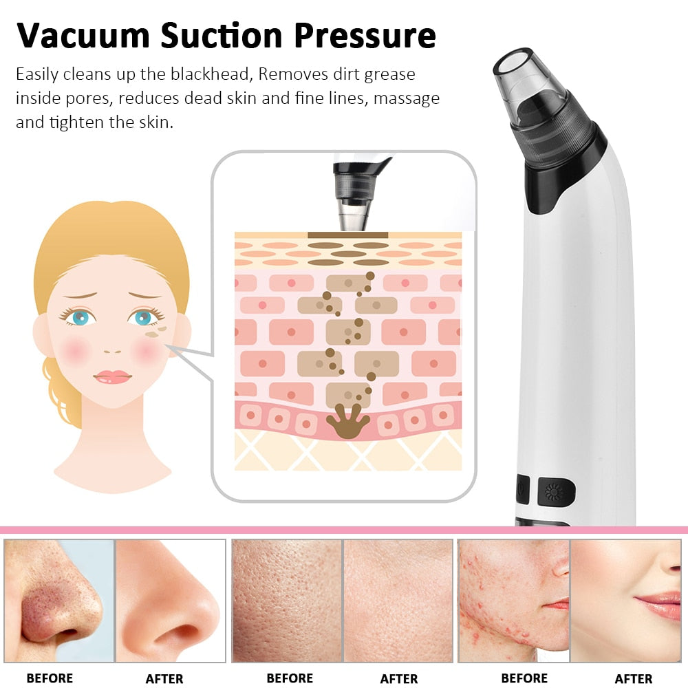 Blackhead Remover USB Facial Cleansing Pore Acne Remover